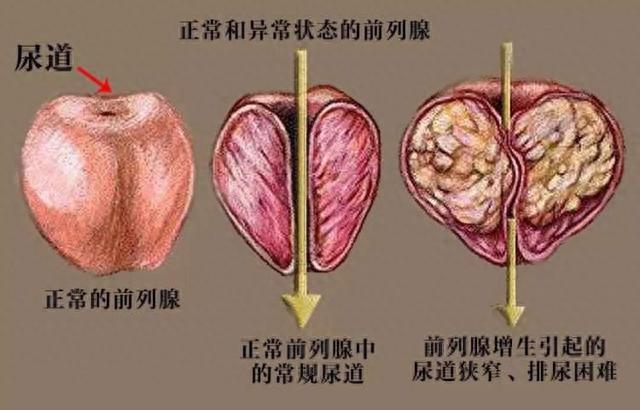 如何预防和治疗前列腺增生来听松江医生的建议｜健康智慧屋